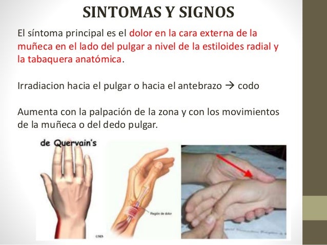 enfermedad de quervain
